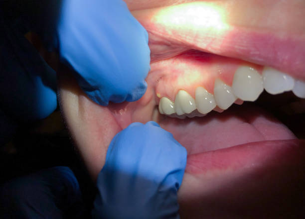 Best Emergency Dentist for Knocked-Out Tooth in Kernersville, NC